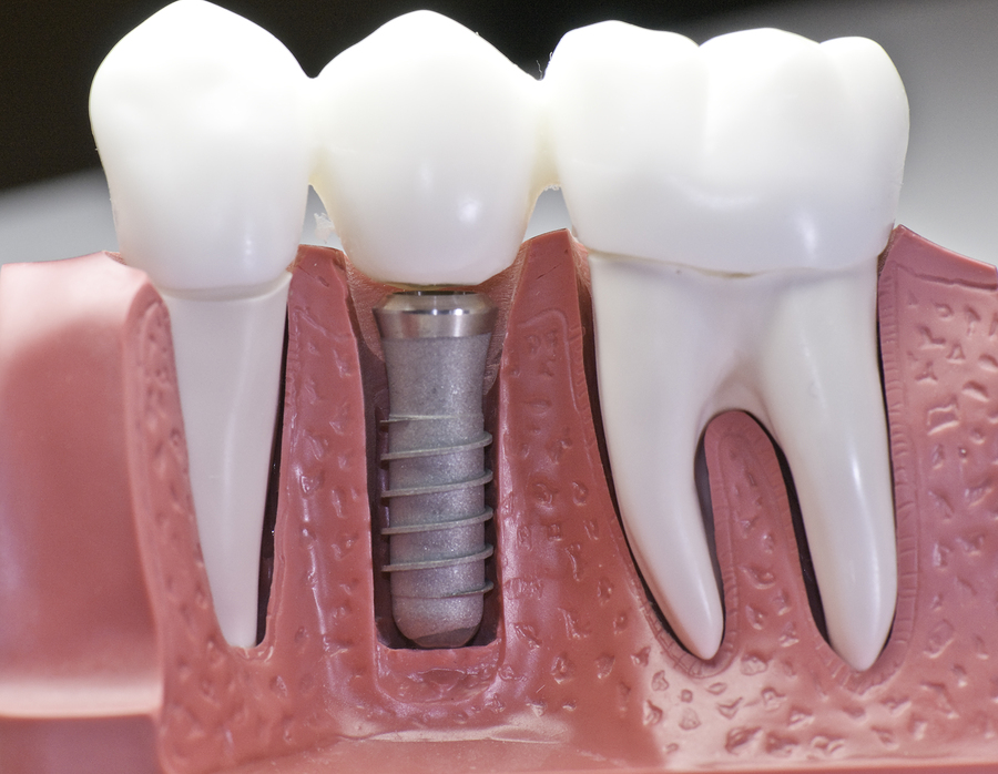 Dental Implants Russellville
